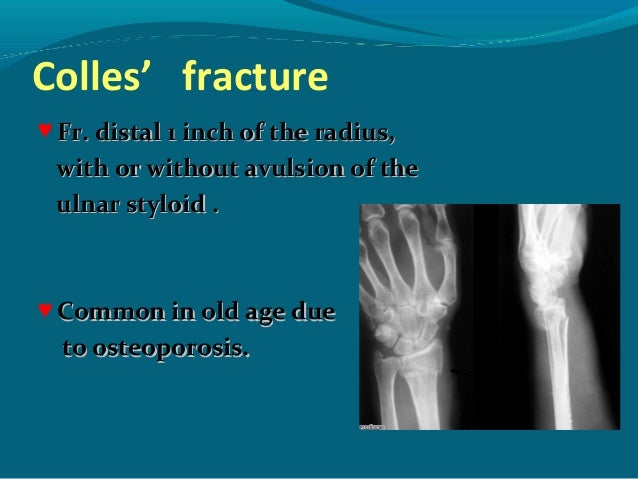 Fractures of the Upper Extremity
